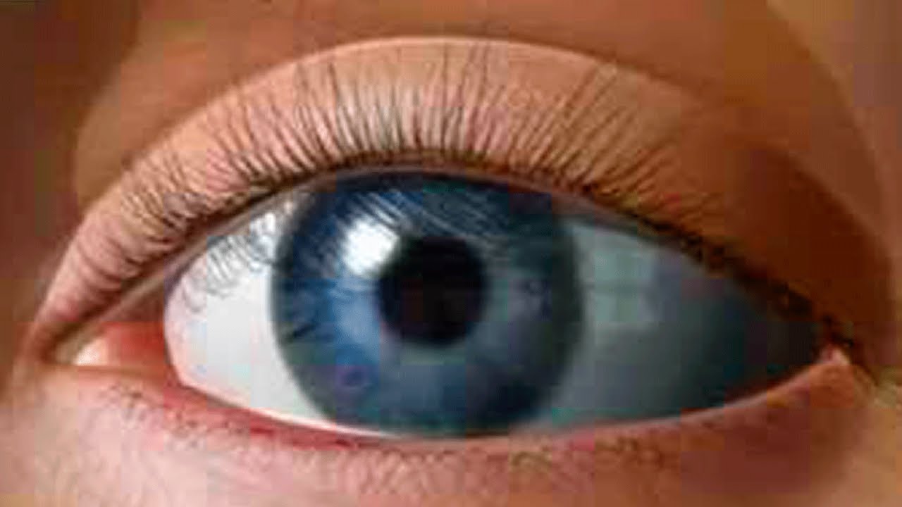 Признаки катаракты, особенности лечения