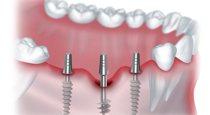 5 мифов о зубной имплантологии